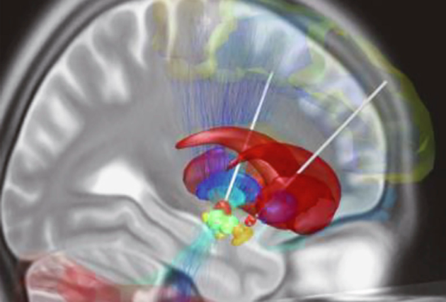 深部脑刺激设备电极通常用于治疗帕金森病 图源：中国工程院院刊